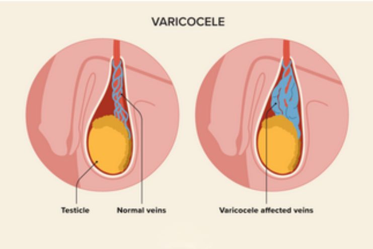 Varicocele