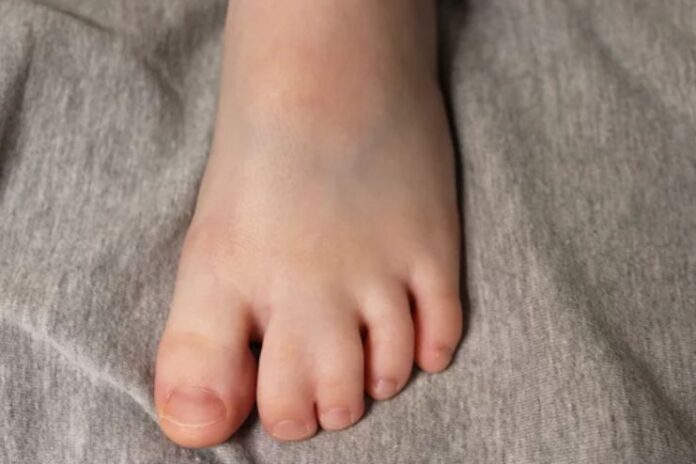 Webbed Toes (Syndactyly)_ Types, Causes, and Treatment