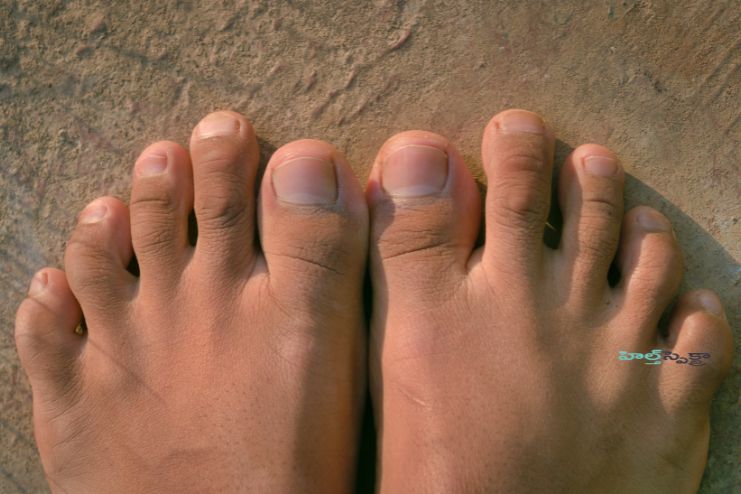What Are Webbed Toes