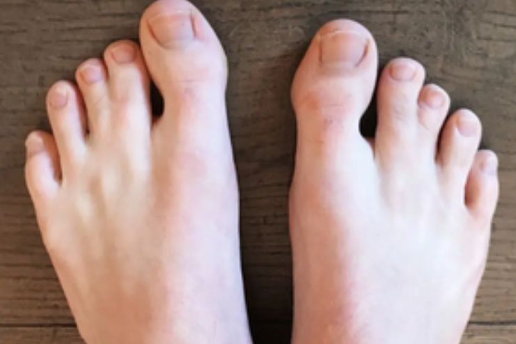 What Causes Webbed Toes