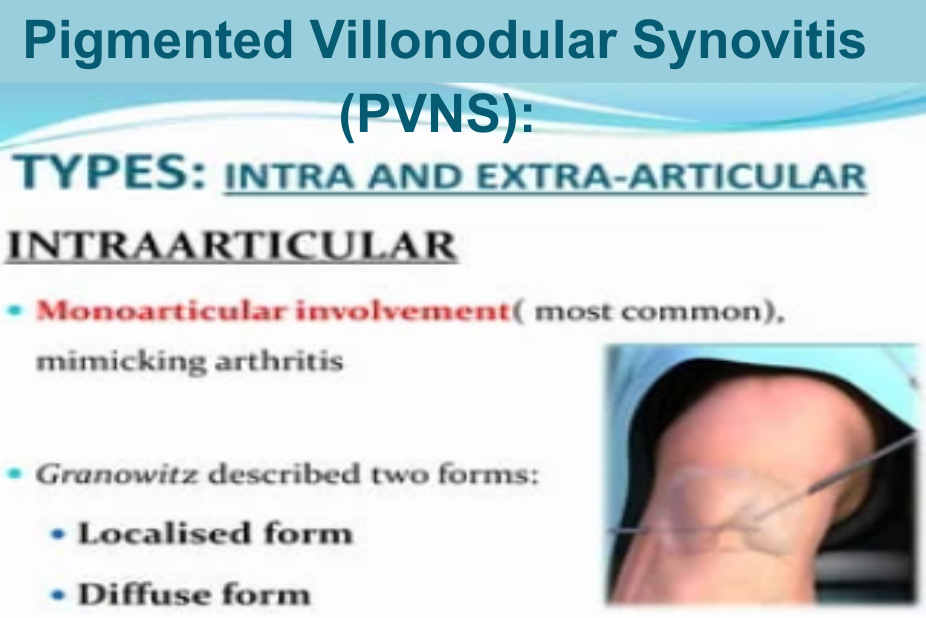 What are the types of PVNS