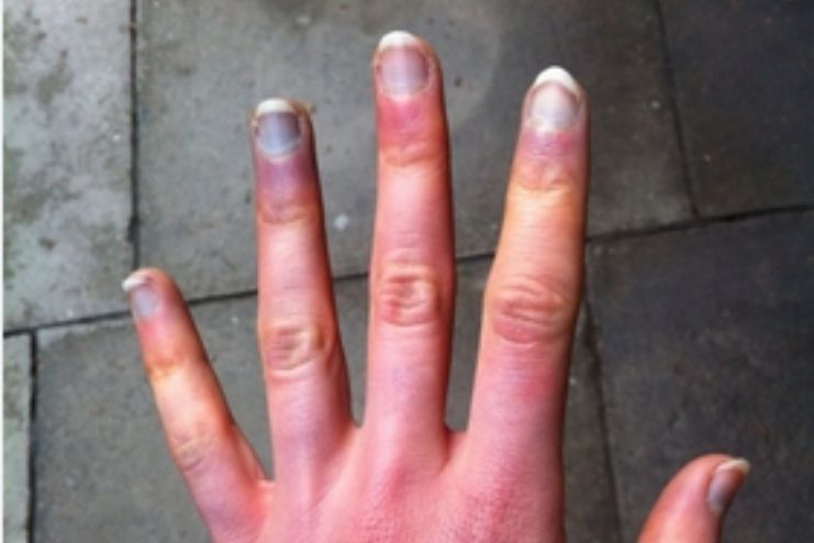 Why Fingernails Turn Blue