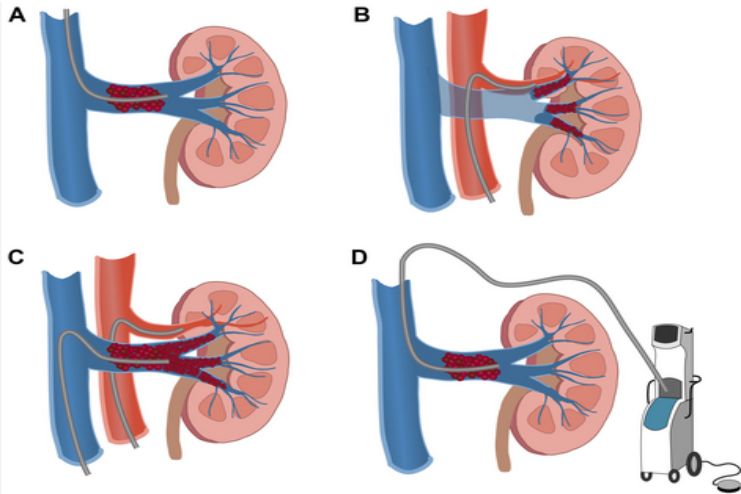 renal vein thrombosis