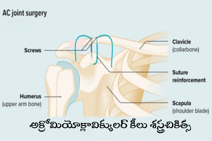 Acromioclavicular (AC) Joint Repairs