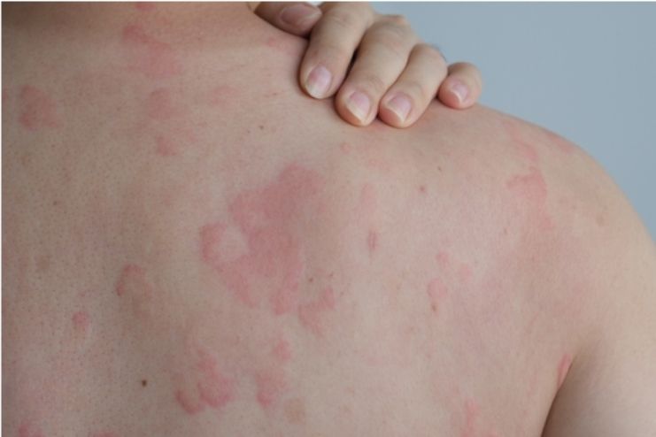 Anaphylaxis- Symptoms, Causes, Treatment, and Prevention 2