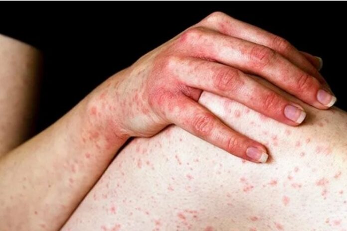 Anaphylaxis- Symptoms, Causes, Treatment, and Prevention