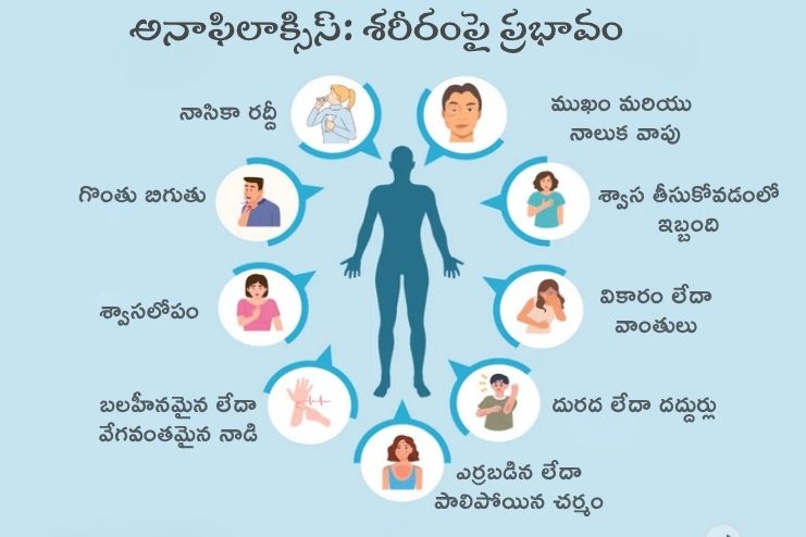 Anaphylaxis affect on body