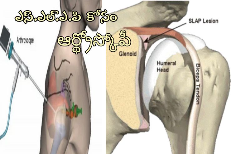 Arthroscopic SLAP Repair