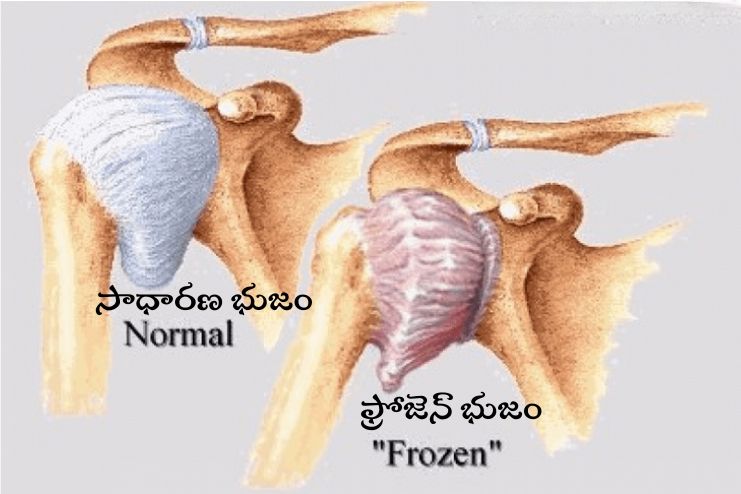 Arthroscopy for Frozen Shoulder