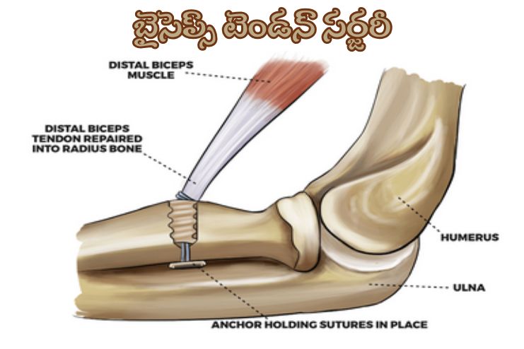 Biceps Tendon Surgery