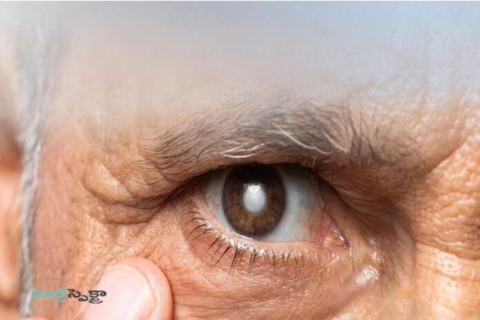 Cataract: Causes, Symptoms, Treatment and Prevention