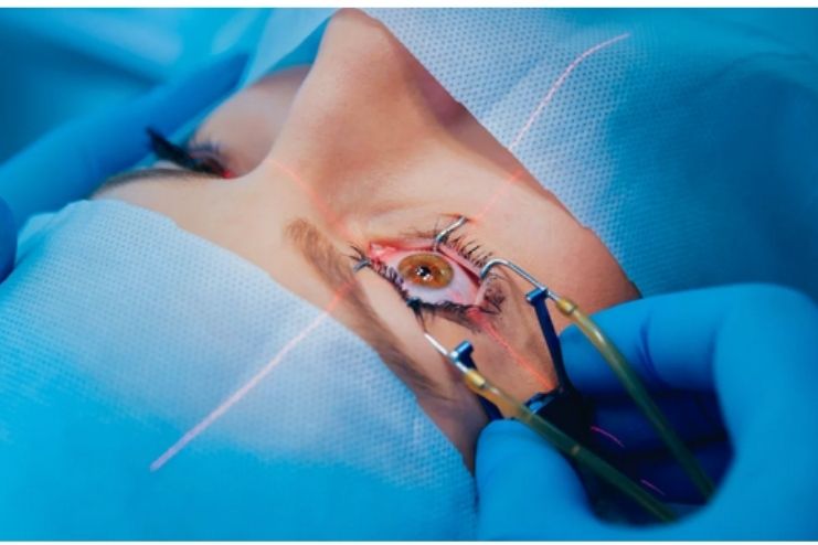 Cataract Surgery Cost