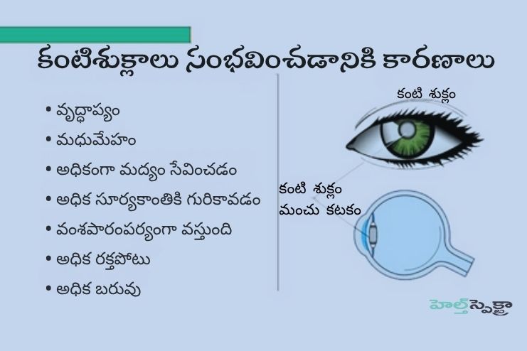Causes of Cataract