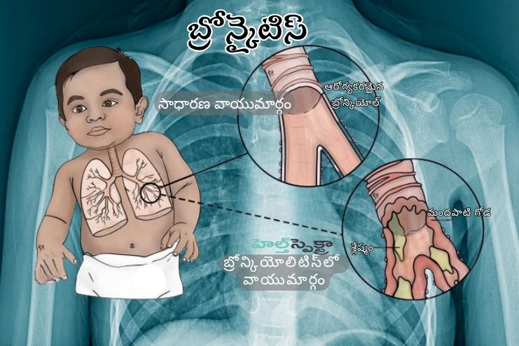 Chest cold (bronchitis)