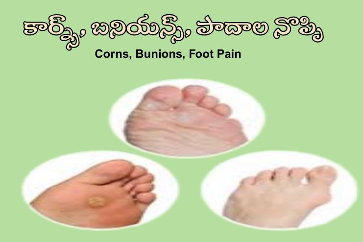 Corns, Bunions, Foot Pain