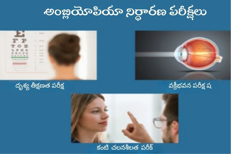 Diagnosis of Lazy eye