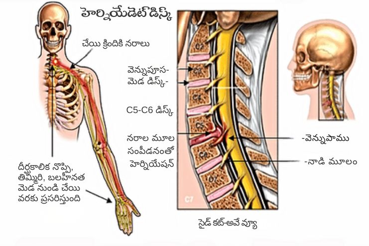 Herniated disk