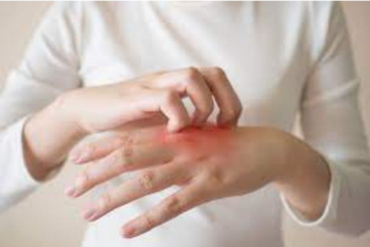 How do allergies lead to anaphylaxis