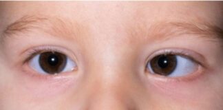 మెల్లకన్ను (అంబ్లియోపియా): కారణాలు, లక్షణాలు, చికిత్సలు - Lazy eye (Amblyopia): Causes, Symptoms and Treatments Lazy eye (Amblyopia)_ Causes, Symptoms and Treatments