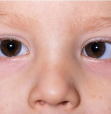 మెల్లకన్ను (అంబ్లియోపియా): కారణాలు, లక్షణాలు, చికిత్సలు Lazy eye (Amblyopia)_ Causes, Symptoms and Treatments