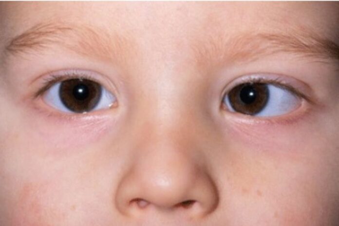 Lazy eye (Amblyopia)_ Causes, Symptoms and Treatments