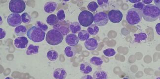 ల్యూకోసైటోసిస్ అంటే ఏమిటీ? కారణాలు, లక్షణాలు, చికిత్స - Leukocytosis: Causes, Symptoms, and Treatment Leukocytosis_ causes, Symptoms & Treatment