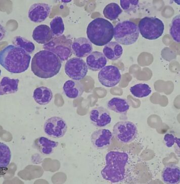 ల్యూకోసైటోసిస్ అంటే ఏమిటీ? కారణాలు, లక్షణాలు, చికిత్స Leukocytosis_ causes, Symptoms & Treatment