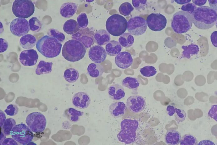 Leukocytosis_ causes, Symptoms & Treatment