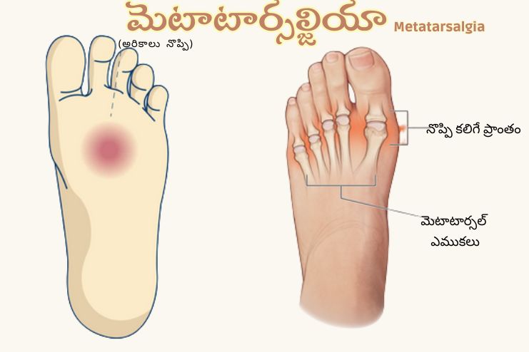 Metatarsalgia