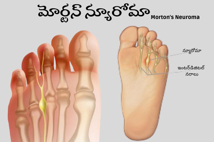 Morton's Neuroma