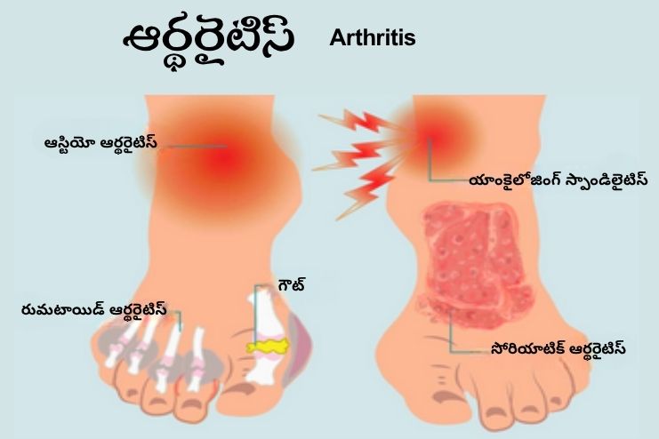 Osteoarthritis