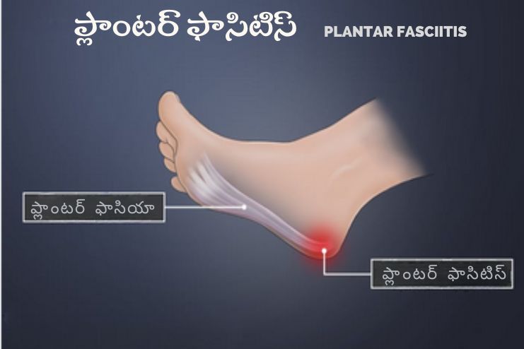 Plantar Fasciitis