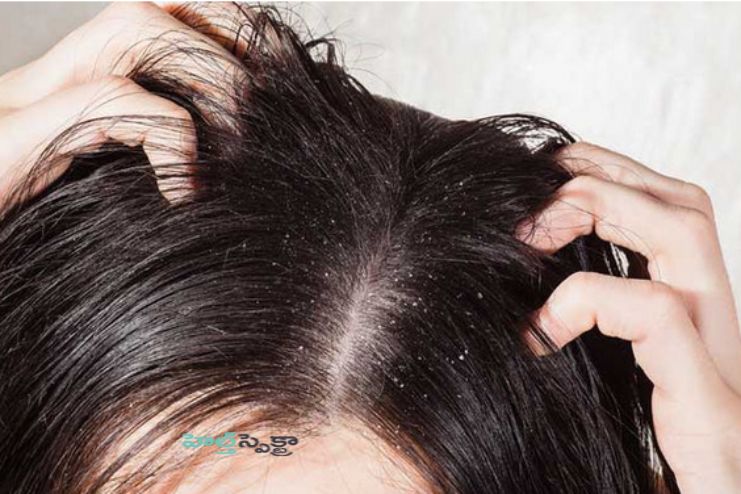 Prevents scalp infections