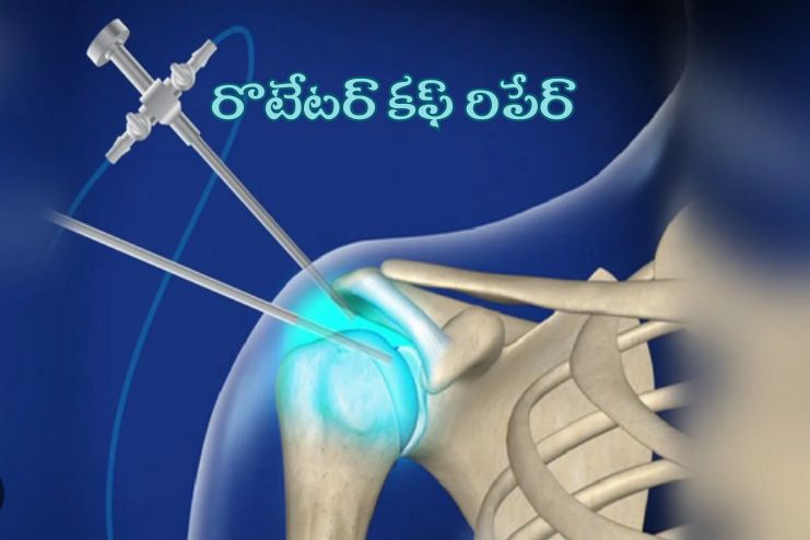 Rotator Cuff Repairs