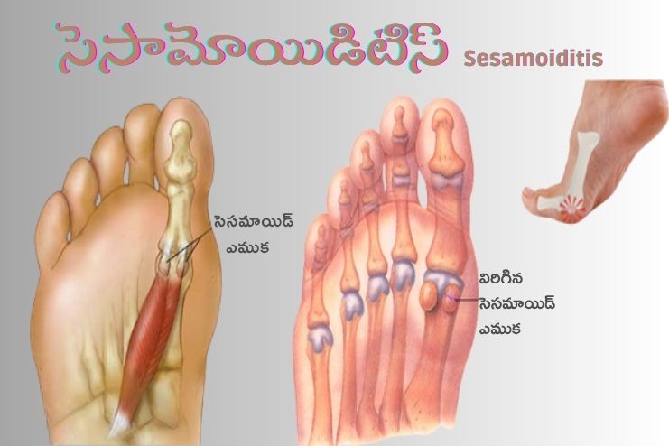 Sesamoiditis