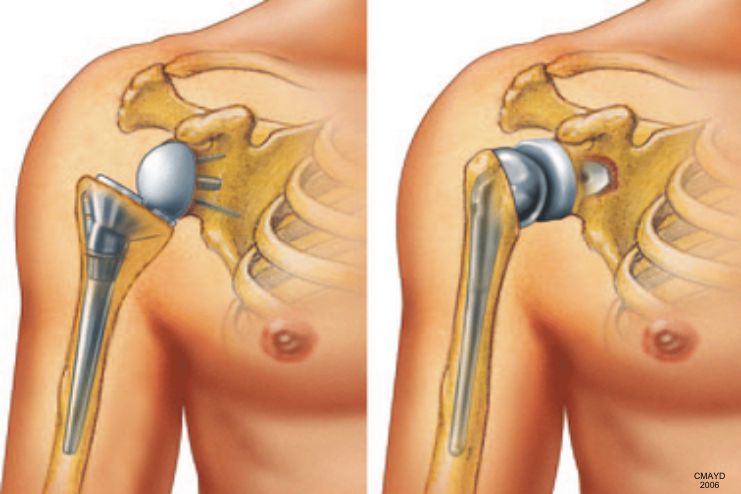 Shoulder Replacement