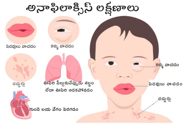 Signs of Anaphylactic Shock