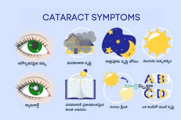 Symptoms of Cataract