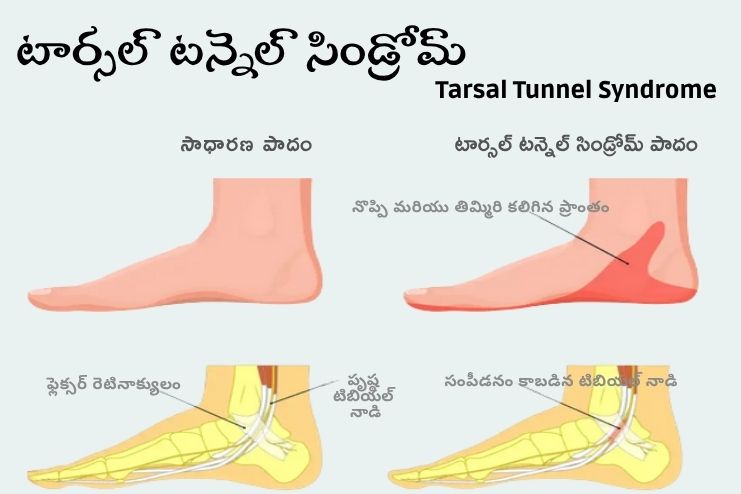 Tarsal Tunnel Syndrome