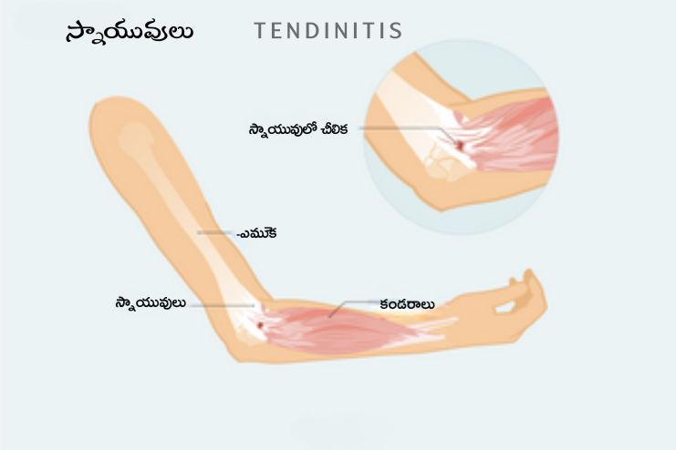 Tendonitis