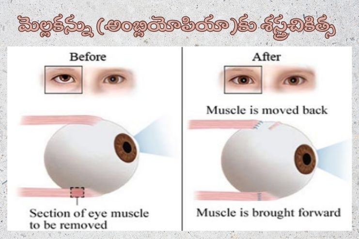 Symptoms of lazy eye