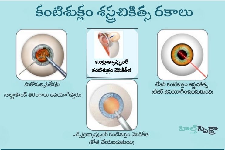 Types of Cataract Surgery
