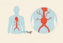 అబ్డామినల్ అరోటిక్ అనూరిజం అంటే ఏమిటీ.? కారణాలు & చికిత్స What You Need to Know About Abdominal Aortic Aneurysms