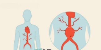 అబ్డామినల్ అరోటిక్ అనూరిజం అంటే ఏమిటీ.? కారణాలు & చికిత్స - What You Need to Know About Abdominal Aortic Aneurysms What You Need to Know About Abdominal Aortic Aneurysms