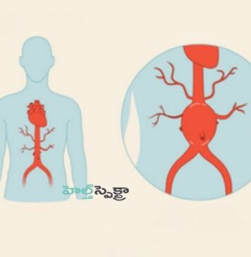 అబ్డామినల్ అరోటిక్ అనూరిజం అంటే ఏమిటీ.? కారణాలు & చికిత్స What You Need to Know About Abdominal Aortic Aneurysms