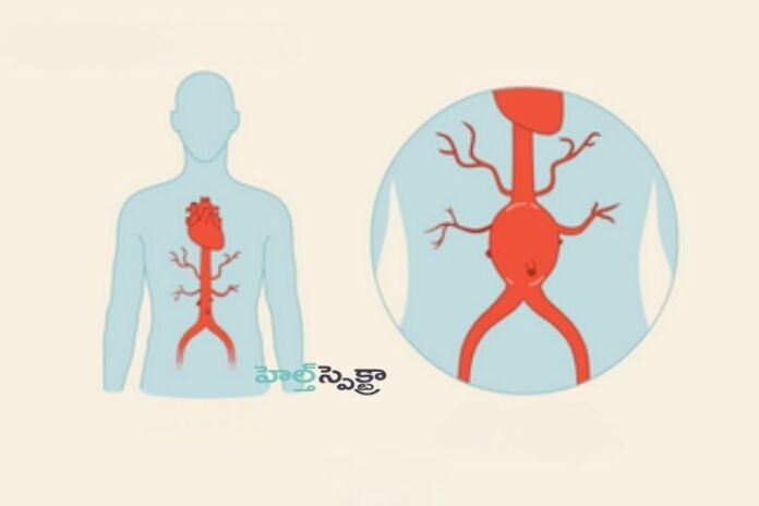 What You Need to Know About Abdominal Aortic Aneurysms