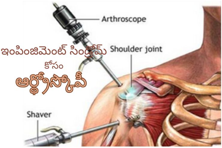 arthroscopy for impingement syndrome