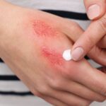 immediate burn injury treatment