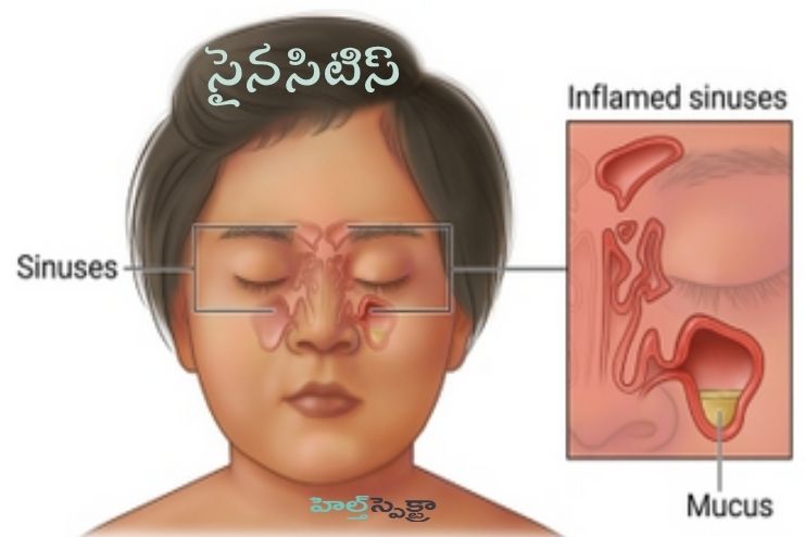 sinusitis