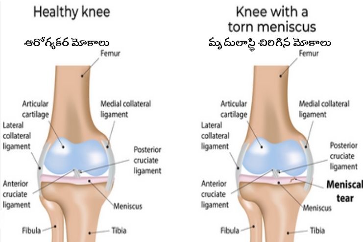 Chronic Degeneration of the Meniscus